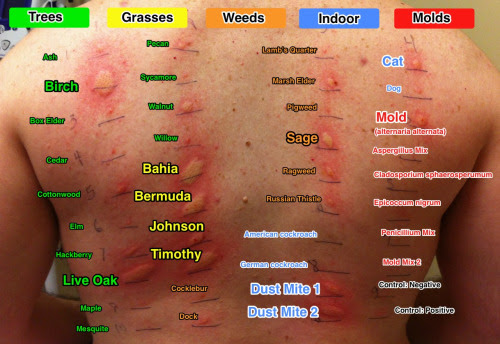 Allergy Skin Test Results